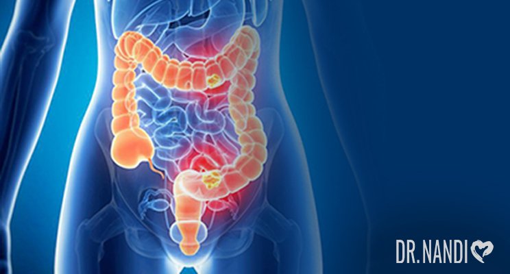 What Is Inflammatory Bowel Disease (IBD)? Symptoms, Causes and Solutions