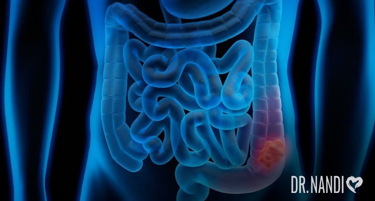 Colorectal Cancer: Symptoms, Causes And Treatment