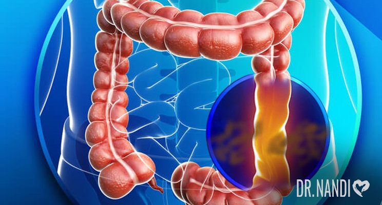 What Is Leaky Gut Syndrome? Symptoms, Causes & Solutions