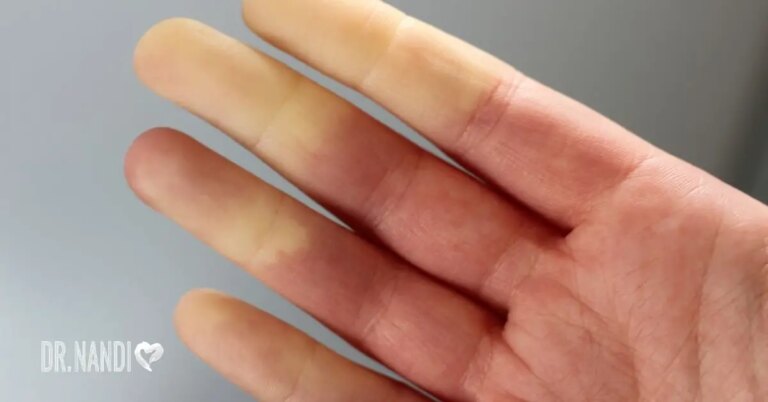 Raynaud’s Disease – Know The Signs