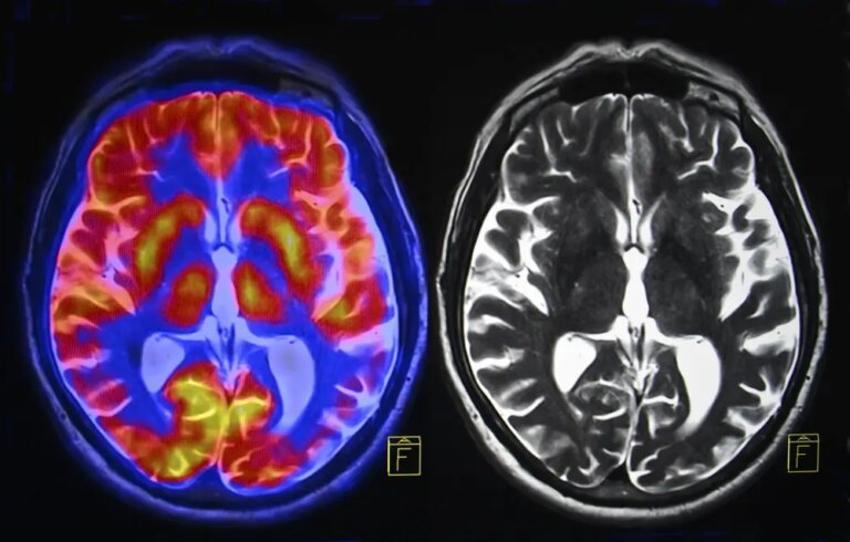 Regular Caffeine Effect Gray Matter of Brain