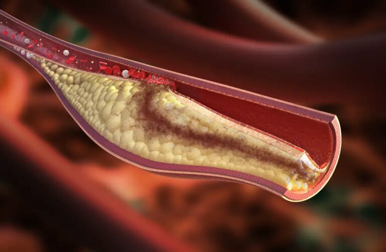 Cholesterol may be Key to New Therapies for Alzheimer’s Disease, Diabetes